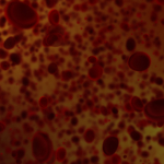 Sepsis (blodförgiftning): symtom, orsaker & behandling